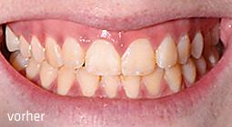 Ein Bleaching zur Zahnaufhellung schwächt oft die Zahnoberfläche, während Emmi-dent das natürliche Weiß der Zähne ganz ohne Bleichmittel widerherstellt. Es ist sanft und schützt ihren Zahnschmelz, die perfekte alternative zum Bleaching.